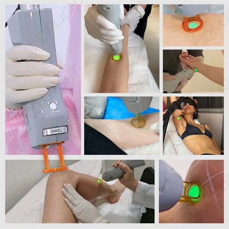 Cynosure Laser Hair Removal Machine