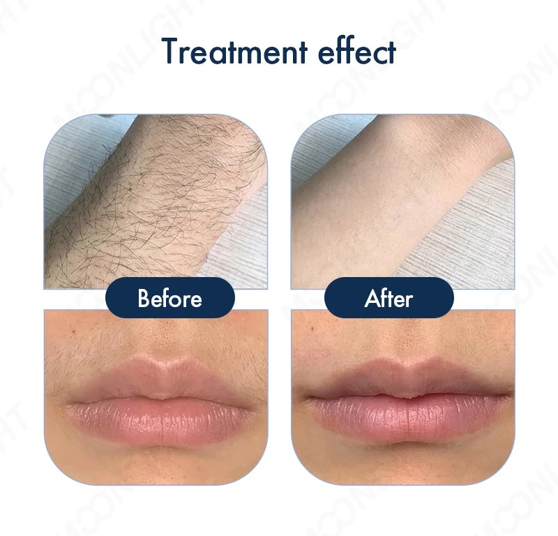 Nd Yag Diode Laser Hair Removal Machine